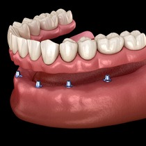 All-on-4 implants on the bottom arch 