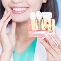 Dentist holding model of dental implant