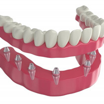 Partial denture on smile model