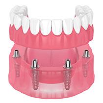 Dental implants inserted into jaw, supporting dentures
