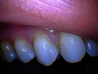 Person with white teeth with not decay