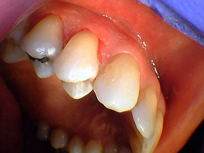 Person with decayed teeth
