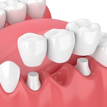 dental bridge