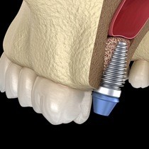 single dental implant post in the upper jaw 