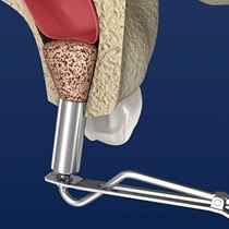 sinus lift procedure 