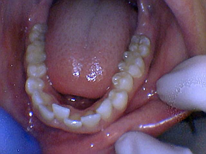 Person with severely misaligned teeth