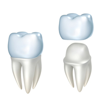 all-ceramic dental crown