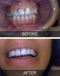 Before and after smile photos of Astoria dental patient