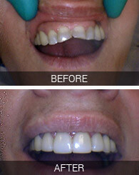 Before and after teeth photos of Astoria dental patient