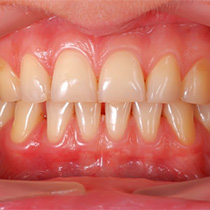 A closeup of a mouth with gum disease.