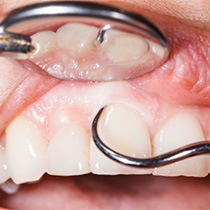 A closeup of a dentist performing scaling and root planing.