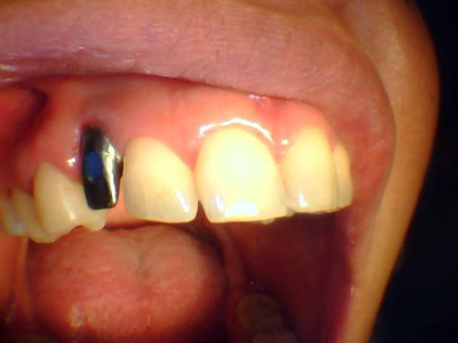 Person with missing tooth and metal stud
