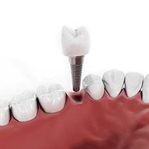 Digital model of a single unit dental implant.