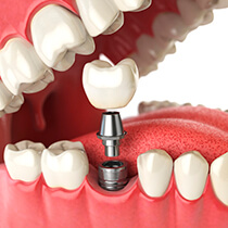 Astoria Dental Implants animation