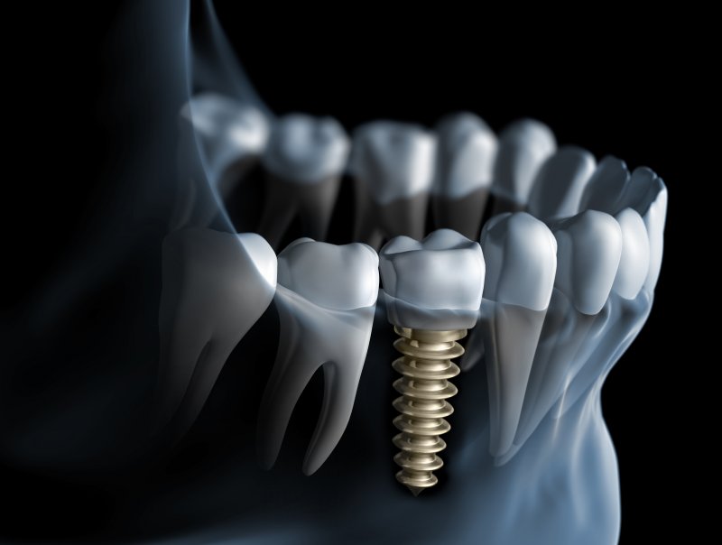 Dental implants in Astoria