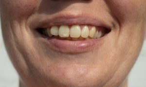 close-up of a person smiling with white spots on teeth in Astoria