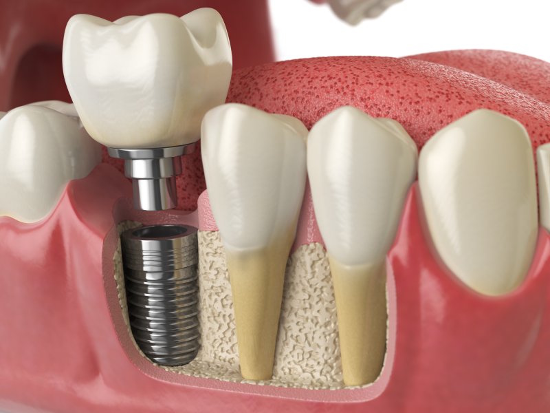 3-D model of a dental implant