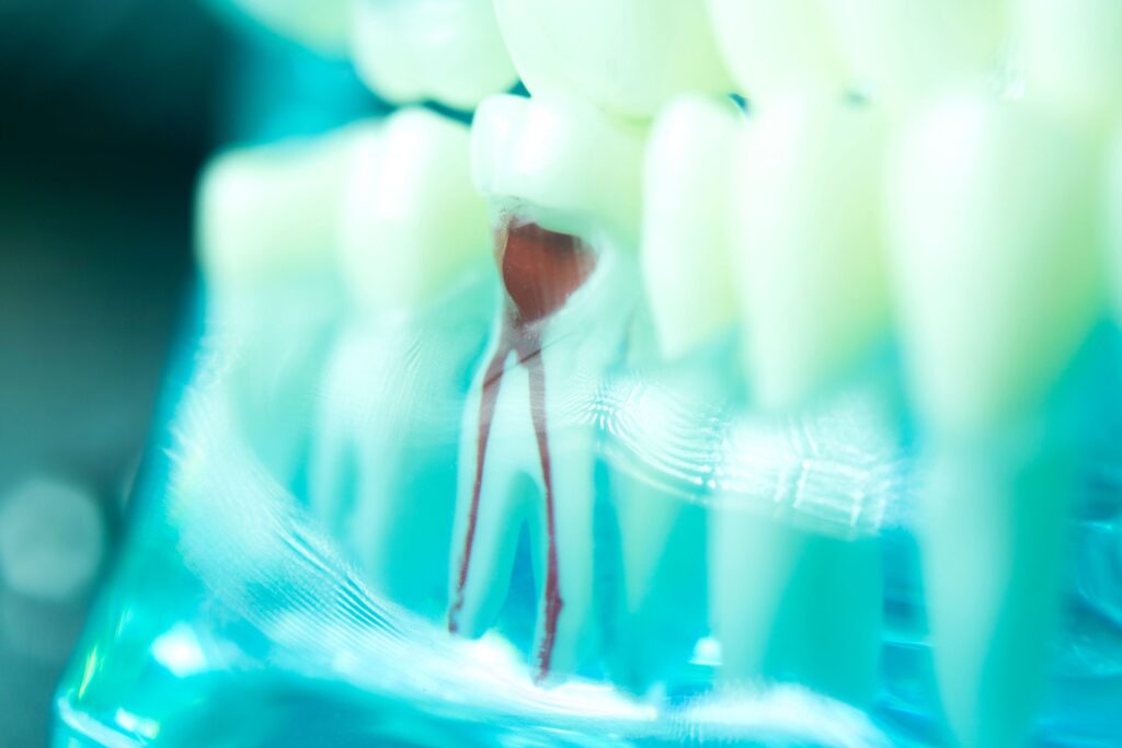 Closeup of damaged lower tooth and roots in transparent jaw